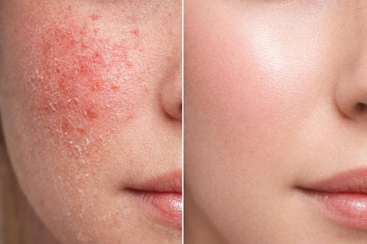 Your Skin Barrier Is Damaged — Here’s What Koreans Use Instead
