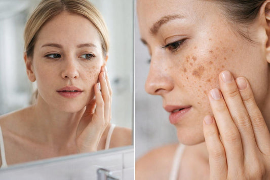 Why Your Dark Spots Won’t Go Away (And What Actually Helps)