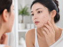 Types of Acne: The Chart to Tell Them Apart — and What Each One Usually Needs