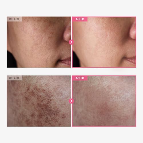 TOSOWOONG Arbutin 7% + Tranexamic Acid 4% Cream, 50ml, 1.69 fl.oz.