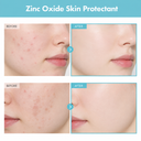 TOSOWOONG Zinc Oxide 10 Cream 50g, 1.76 oz.